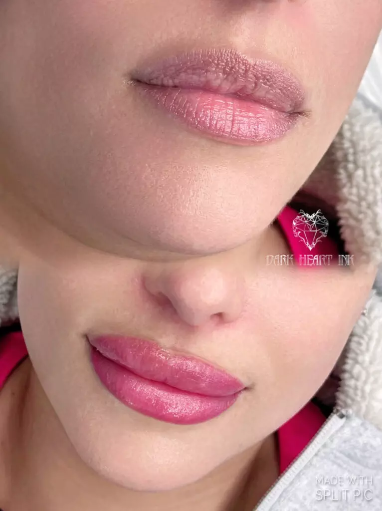 A woman's lips transformation displayed in a gallery before and after lip injections.